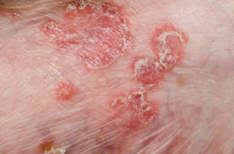 Psoriasis