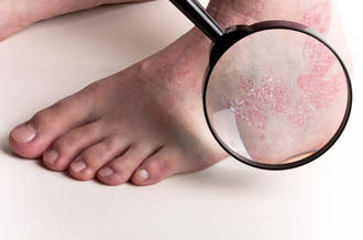 Psoriasis