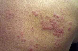 Le zona, c’est quoi?