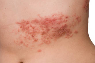 Le zona ou quand le virus de la varicelle se manifeste à nouveau