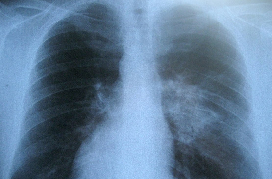 elfbar nachfll pod luft aus Cigarette lectronique et emphysme pulmonaire