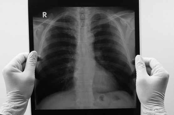 Traitement de la tuberculose : retour vers le passé