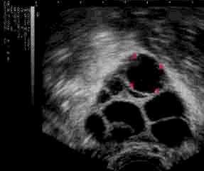 Echographie d'un ovaire montrant la présence de plusieurs follicules