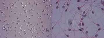 Photos de spermatozoïdes après lavage et spermatozoïdes colorés au Papanicolaou