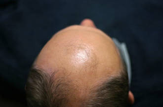 Calvitie