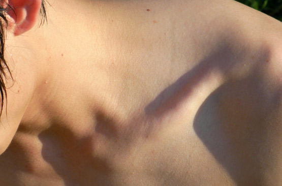 Hypothyroidie Planete Sante