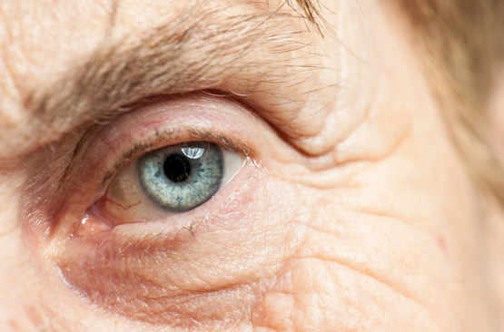Cécité des personnes âgées : l’espoir des cellules souches contre la DMLA