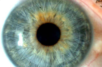 La greffe de cornée permet de retrouver une vision normale