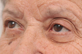 Malvoyance: les promesses des greffes de cellules-souches