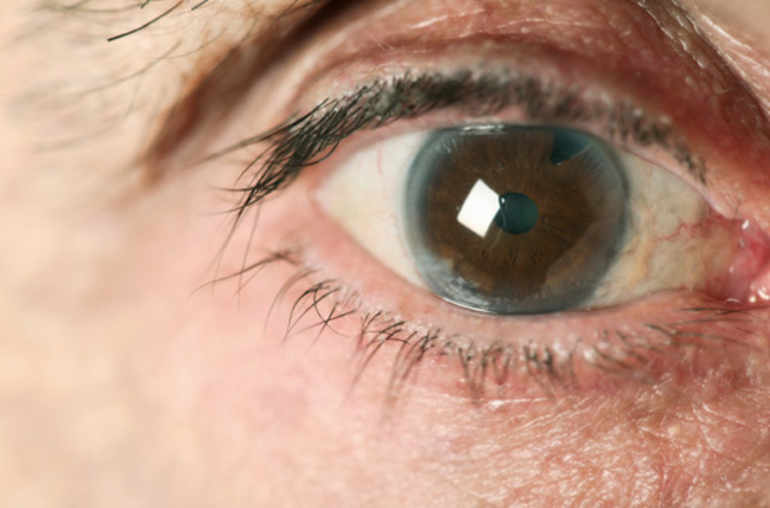 Dermatite yeux traitement, Hpv condylome traitement