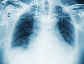 BPCO_epidemie_silencieuse