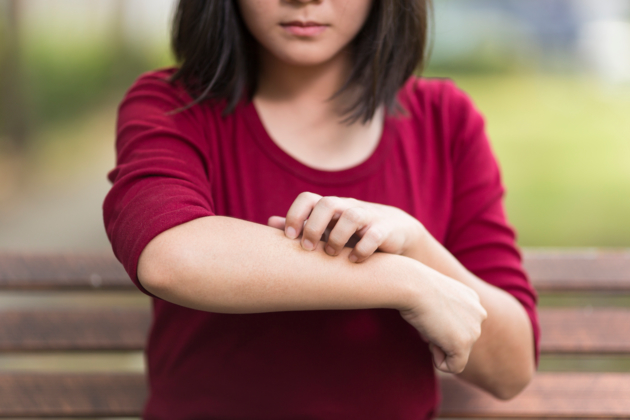 L Eczema De Contact Allergique Planete Sante