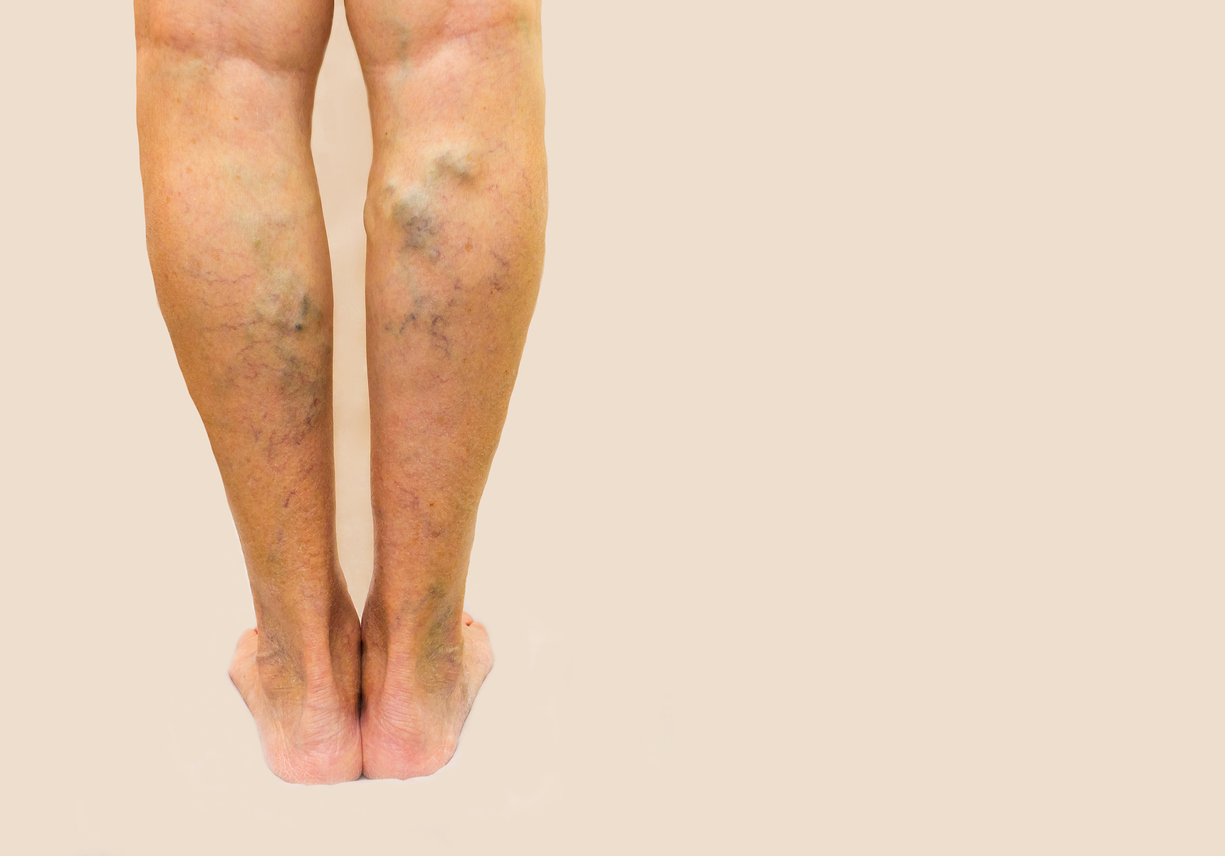 piele întunecata pe picioare în varicoza este posibil sa se piarda în greutate în varicoza