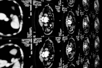 gros_plan_anevrisme_cerebral