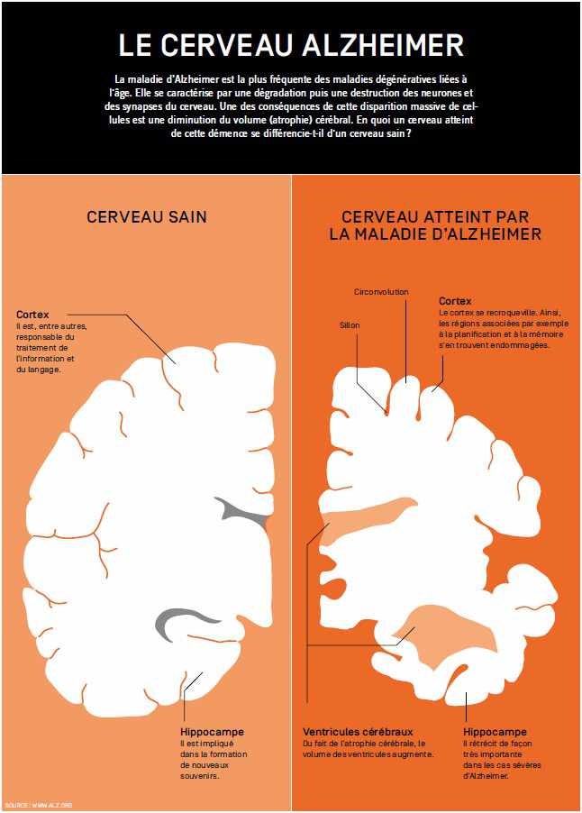 infog_zoom_alzheimer