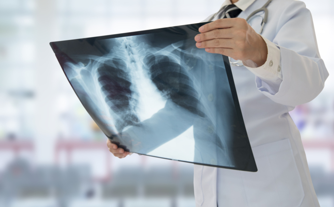 Zoom sur la fibrose pulmonaire - Planete sante Zoom sur la fibrose pulmonaire - Planete sante
