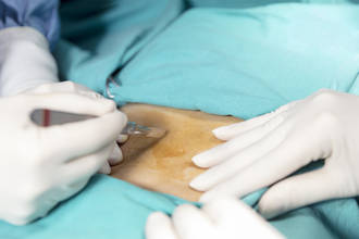 ondes_remplacent_scalpel