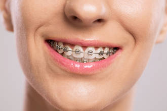 orthodontie_adultes_aussi