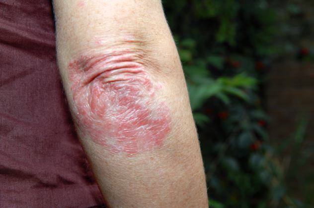 Le psoriasis - Planete sante