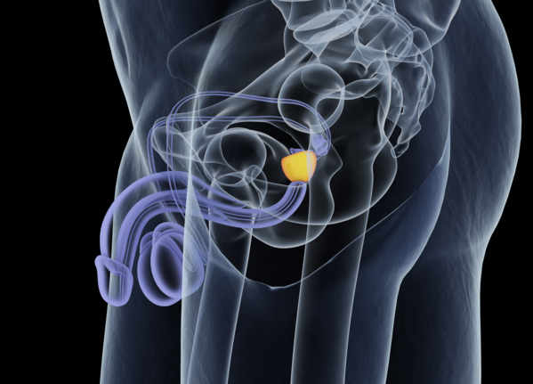 radiotherapie_cancer_prostate