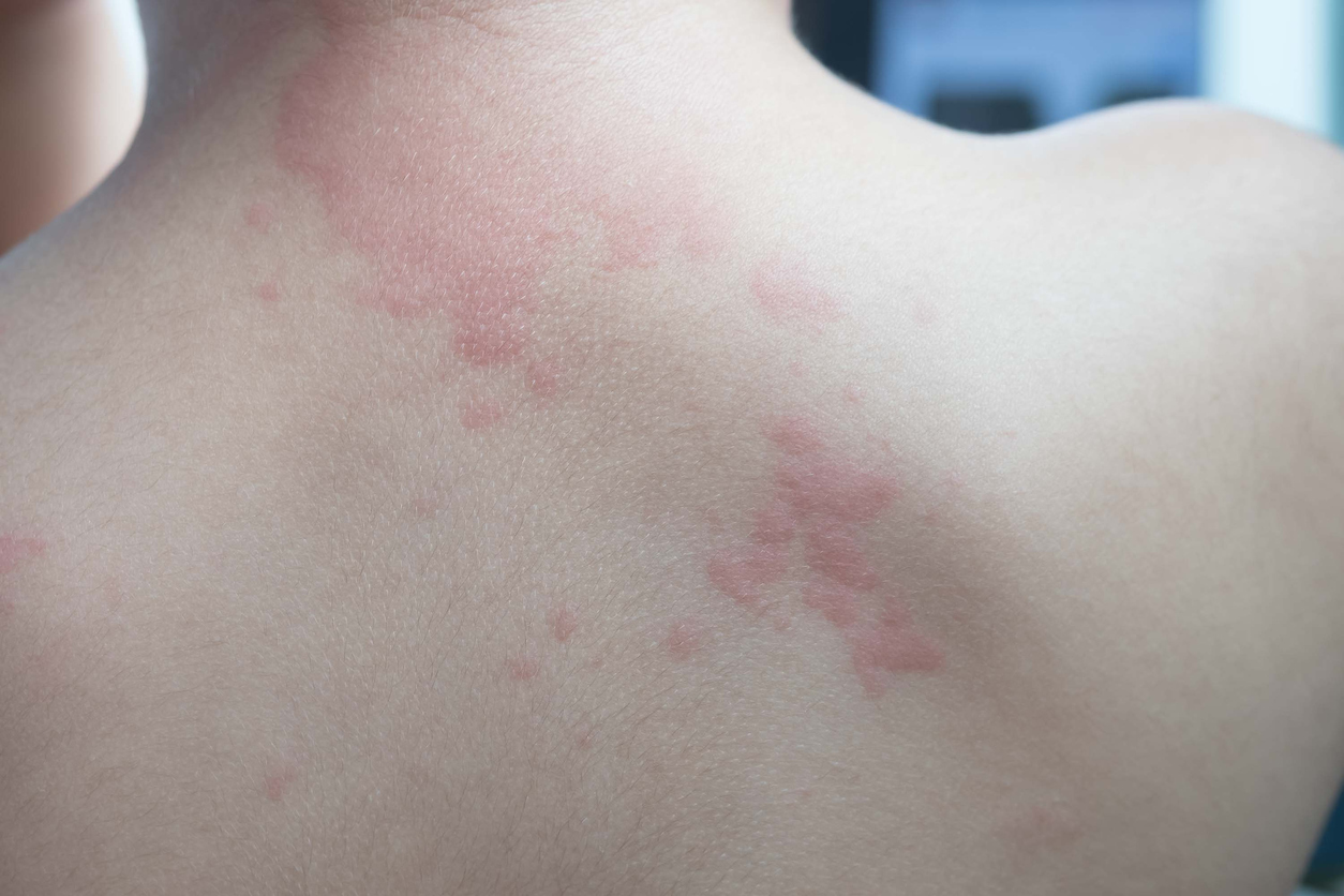 Réactions allergiques: reconnaître les manifestations localisées ...