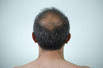 traitement_calvitie_solutions