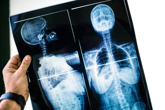 traitement_osteoporose