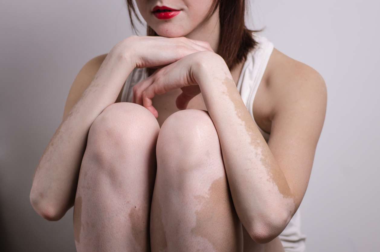 Traitée à temps, la progression du vitiligo peut être ralentie ...