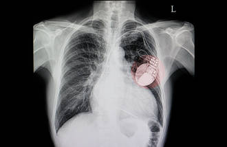 36.9_implant_cardiaque_rend_fou
