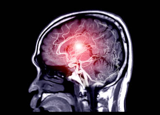 bases_genetiques_anevrisme_intracranien