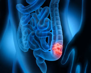 cancer_colon_depistage