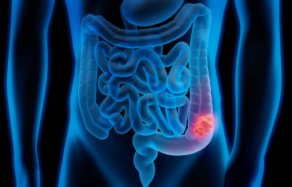 cancer_colorectal_hausse