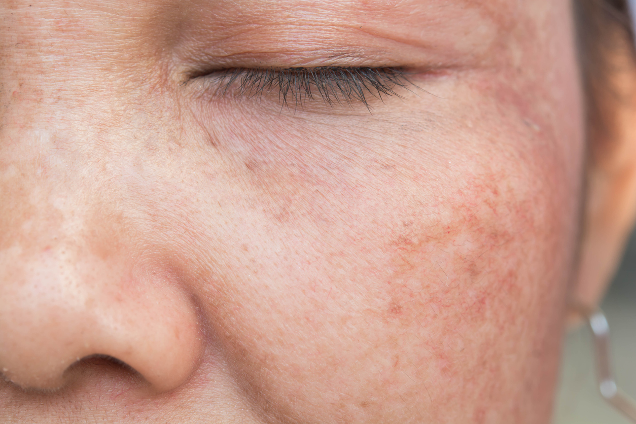 Dermatologie: quelles solutions aux maux de la peau - Planete sante
