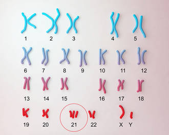 down-syndrome-karyotype