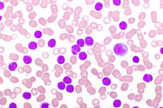 forte_exposition_pesticides_liee_forme_leucemie