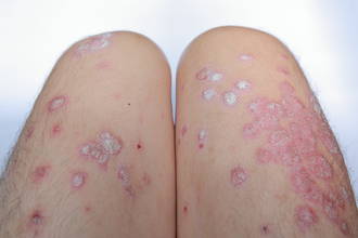 hidradenite_suppurative_maladie_peau_meconnue_douloureuse