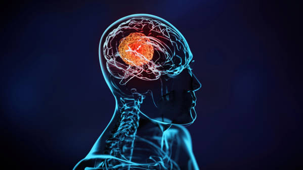 immunotherapie_tumeur_cerveau