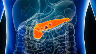 LMD_Cancer_Pancreas