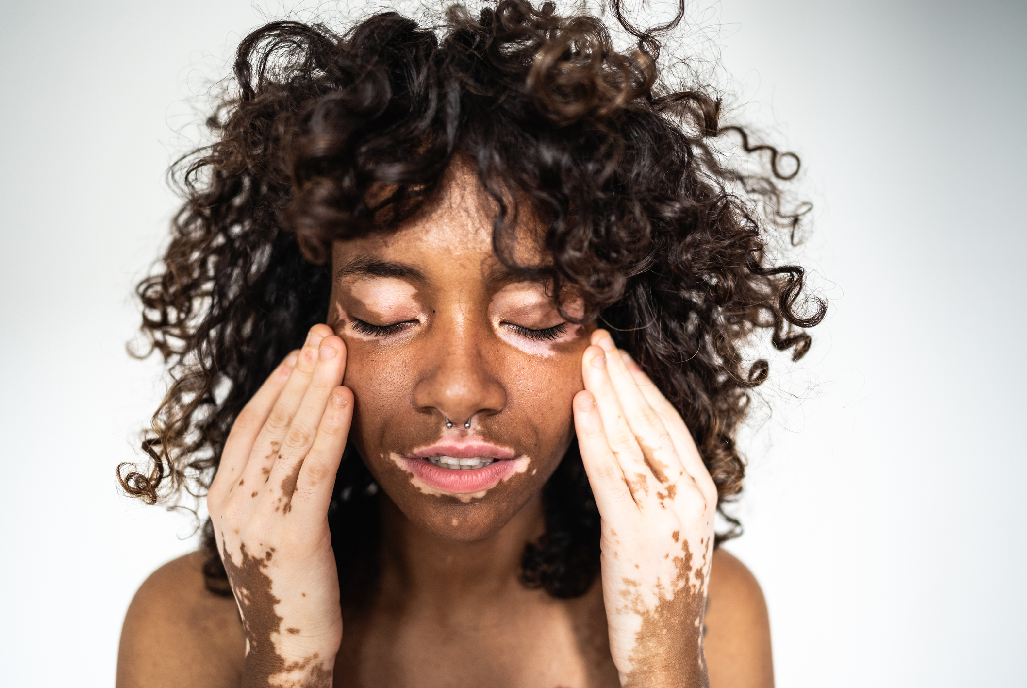Vitiligo: la palette de traitements s'étend - Planete sante