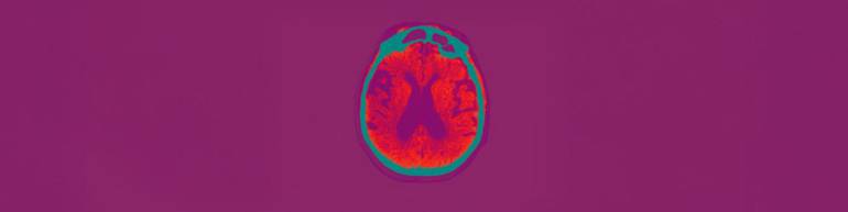 P26_03_Alzheimer