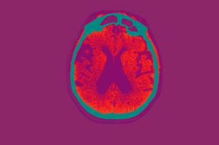 P26_03_Alzheimer