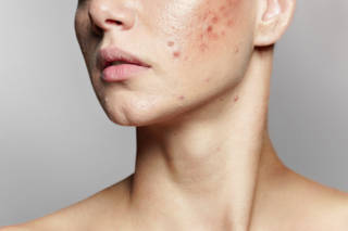 PULS_infog_acne