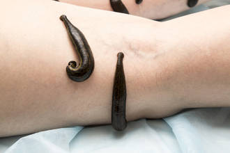 saignee_pratique_disparue