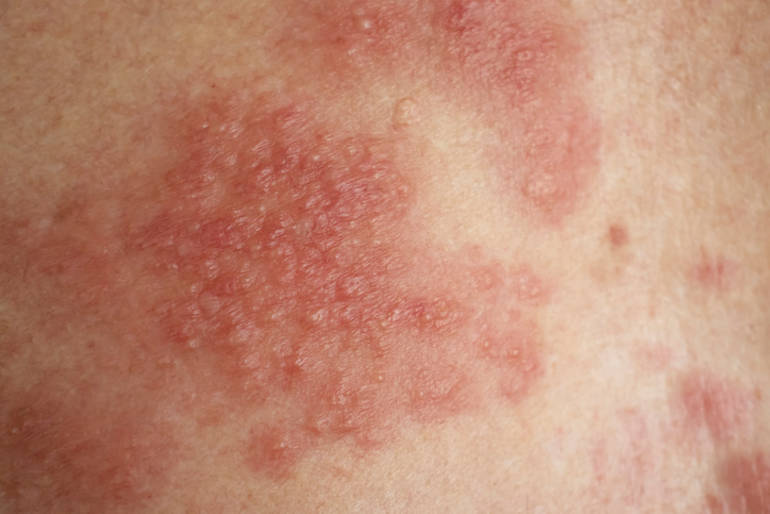 stress_aggravation_eczema