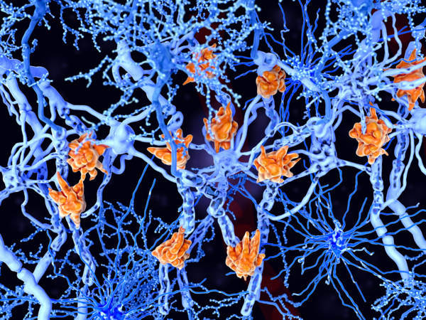 therapie_sclerose_plaques