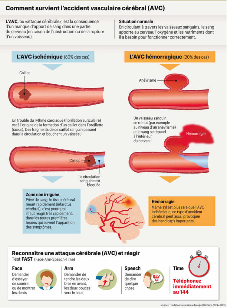 Comment survient l'accident vasculaire cérébral (AVC)