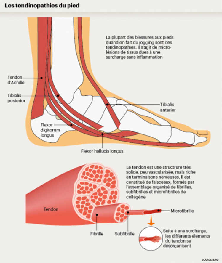Les tendinopathies du pied