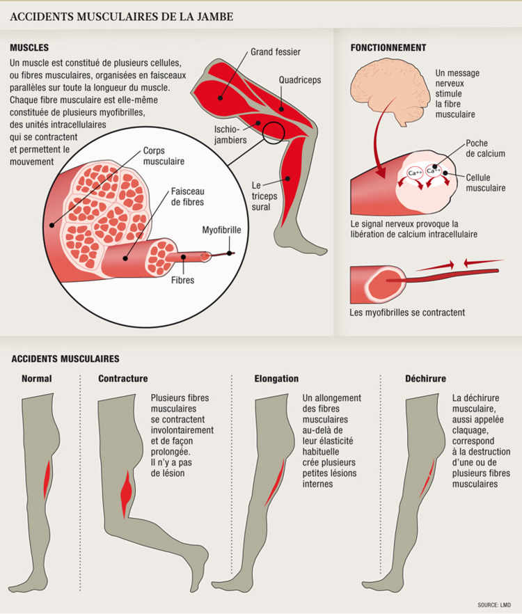 Accidents musculaires de la jambe