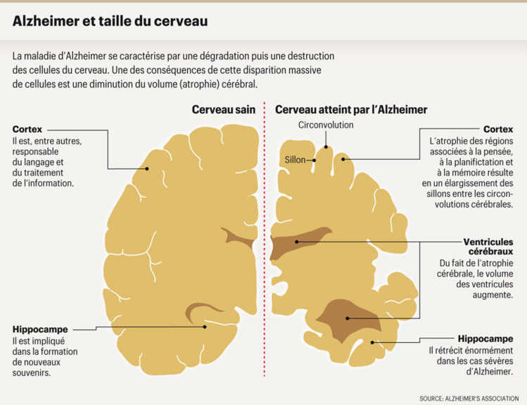 Alzheimer et taille du cerveau