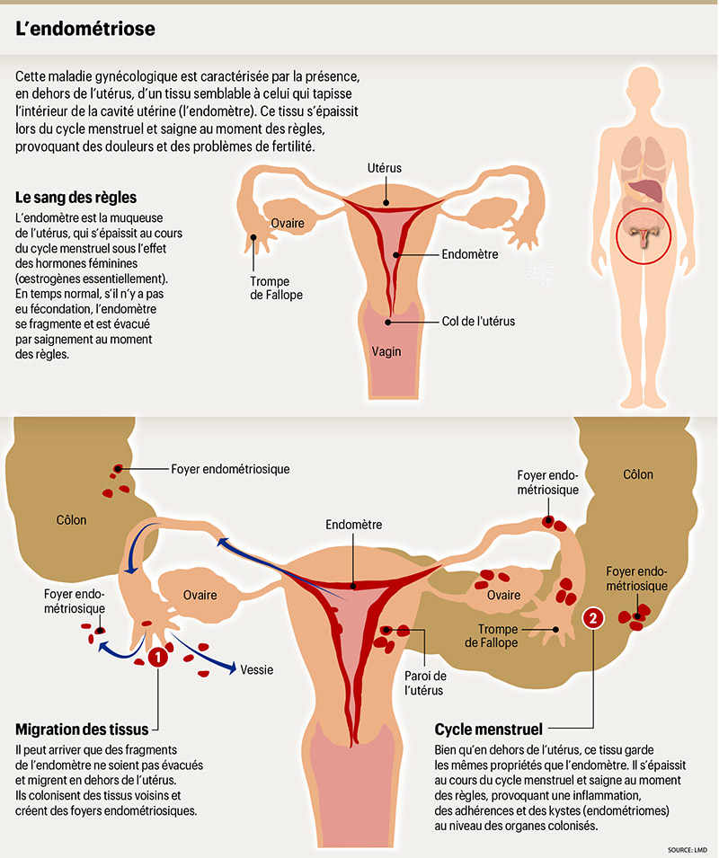 L'endométriose fait souffrir plus d'une femme sur dix - Planete sante